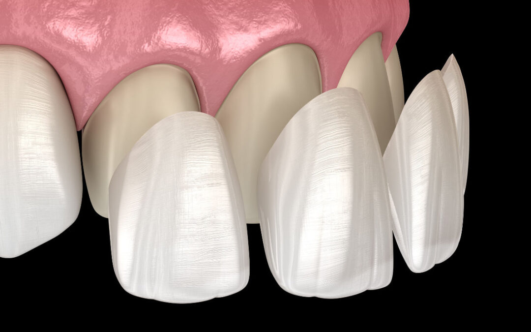 Veneers
