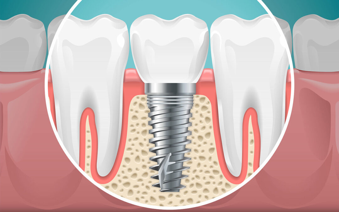 Implantat große Lücken