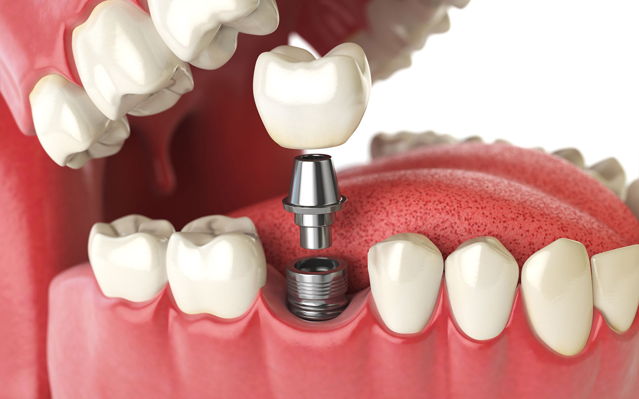 Zahnlücken und Zahnersatz